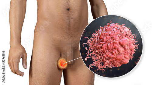 Testicular cancer, medical 3D illustration photo