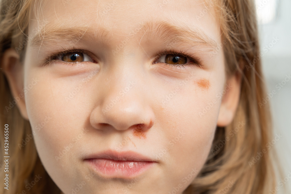 Portrait girl with an abrasion under her eye. child abuse. wounds and abrasions Portrait girl with an abrasion under her eye. child abuse. wounds and abrasions