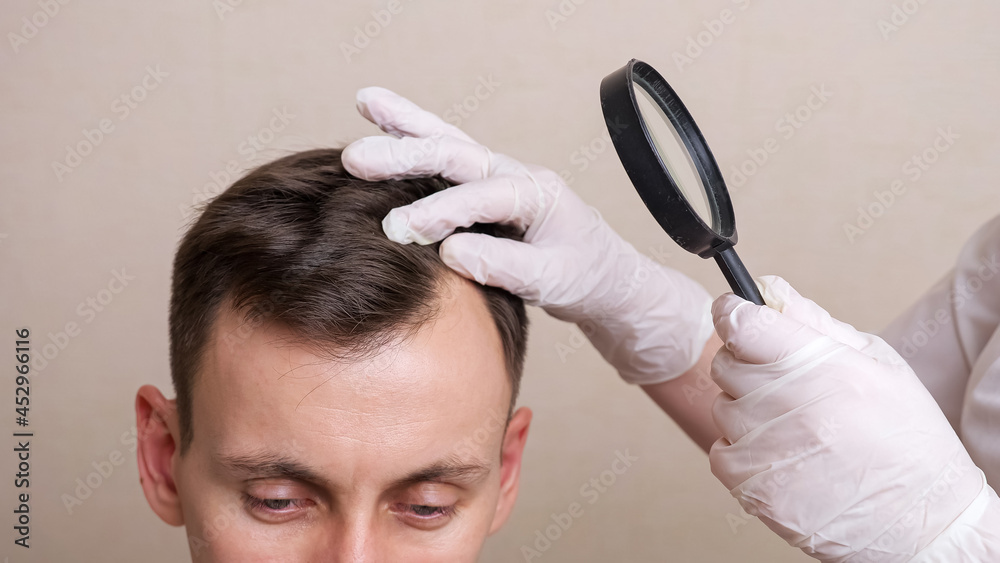 medical professional with gloves and a magnifying glass examines the head of a young man closeu. - obrazy, fototapety, plakaty 