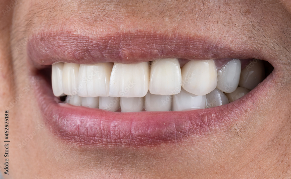 Obraz premium press ceramic crowns and veneers