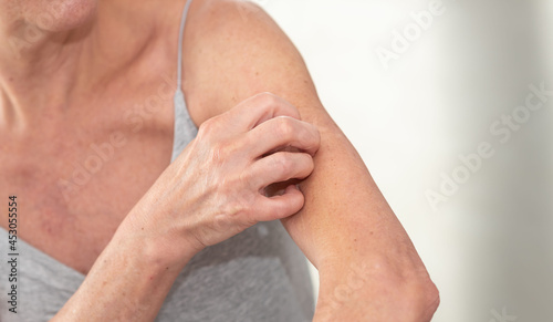 Woman having itchy and scratching her arm