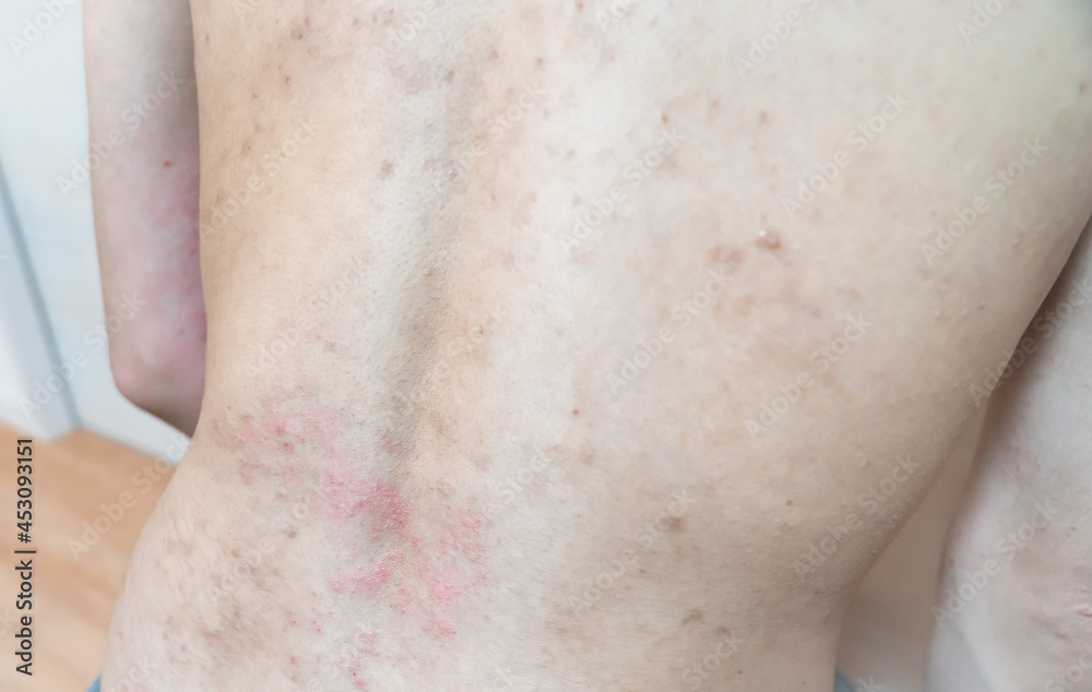 Naklejka premium アトピー / あせも / 皮膚炎のイメージ。 肌荒れ男性の写真。