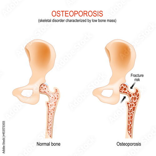 Osteoporosis. normal hip joint and bone with low bone mass.