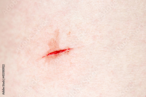 Vászonkép Cut on the body