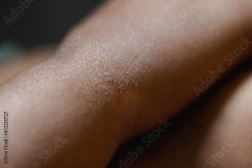Close up of mild eczema on Black skin, newborn, dermatologist 
