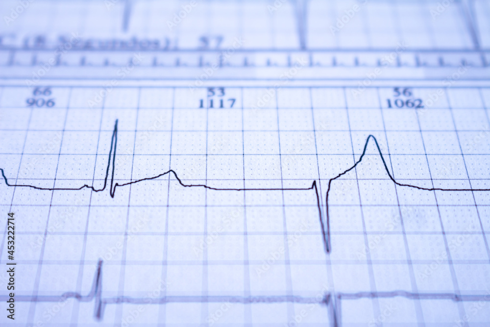 Close-up view of heartbeat with arrhythmia.Cardiovascular disease