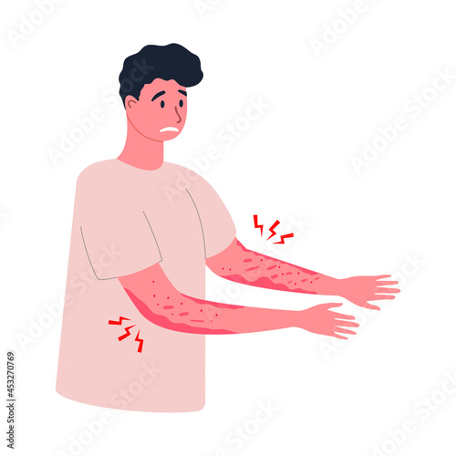 Flat vector illustration of an unhappy suffering man scratching the skin on hand. Various skin problems, such as allergies, psoriasis, itching, atopic dermatitis, eczema, dryness, redness.