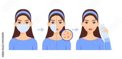 Woman with Medical Mask on Face. Protection against Coronavirus. Girl Wears a Surgical mask, Covering Mouth. Problems Skin. Pimples Acne. Female Character Holds a mask in Hand. Cartoon style. Vector