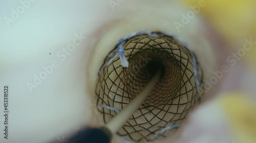 A partially covered self-expandable metallic stent. photo