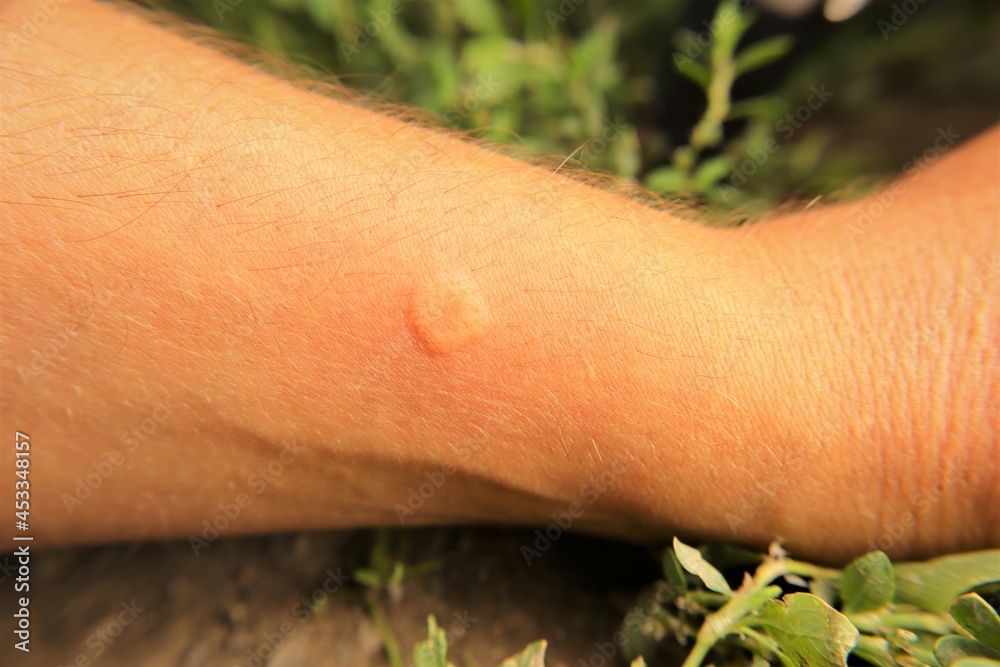 Skin allergy, allergic. Yellow wasp stung by a wasp worker. Yellow