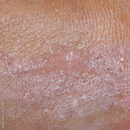 Tableau sur toile Macro of dry skin of a woman's body