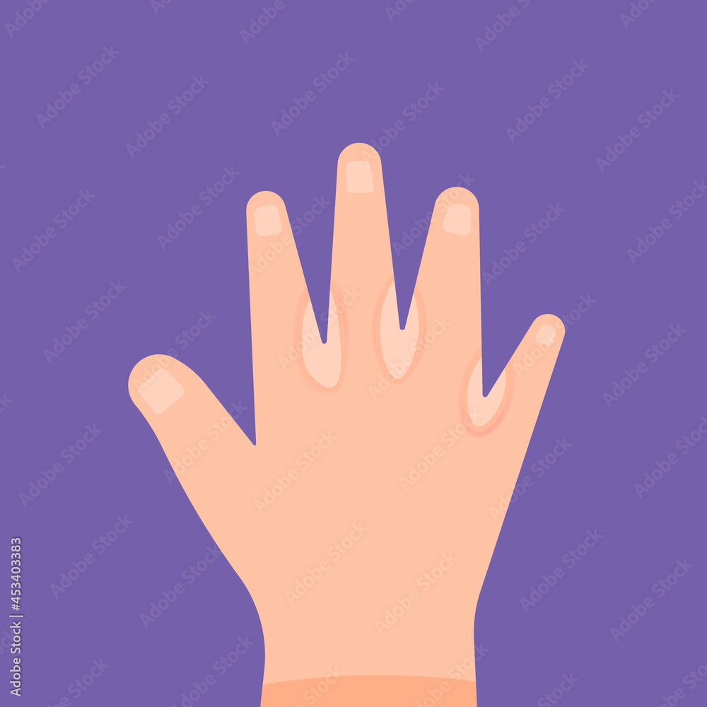 illustration of a hand affected by skin disease or ringworm between the fingers. fungus on the skin. flat cartoon style. vector design elements illustration of a hand affected by skin disease or ringworm between the fingers. fungus on the skin. flat cartoon style. vector design elements