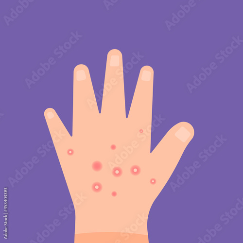 illustration of hands affected by skin diseases, bumps, skin pimples, boils. itchy red itchy skin. fungus on the skin. flat cartoon style. vector design elements