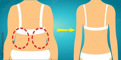 Back of a woman before and after losing weight