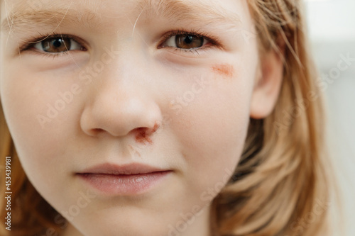 Portrait girl with an abrasion under her eye. child abuse. wounds and abrasions