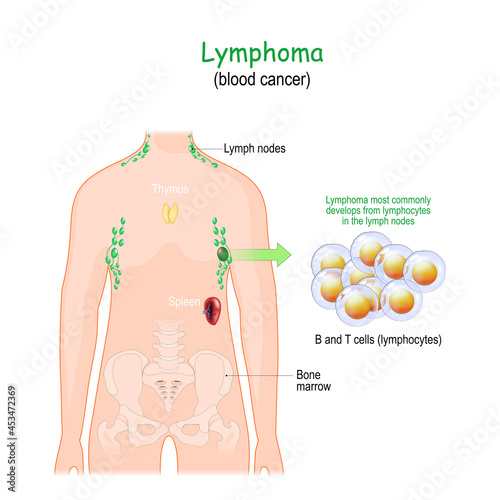 lymphoma or blood cancer photo