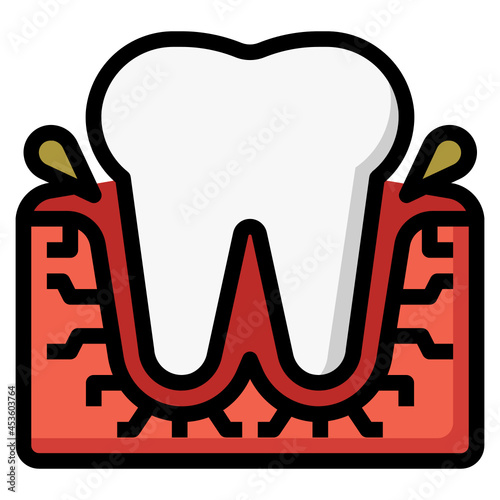 gingivitis