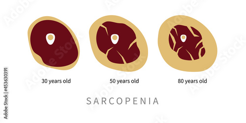 Sarcopenia in elderly. Replacement of muscle tissue photo