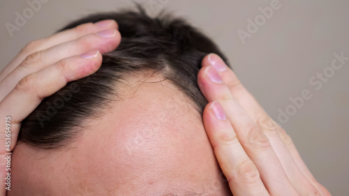 Man with bald spots suffering from hair loss. Treatment of hair problem.