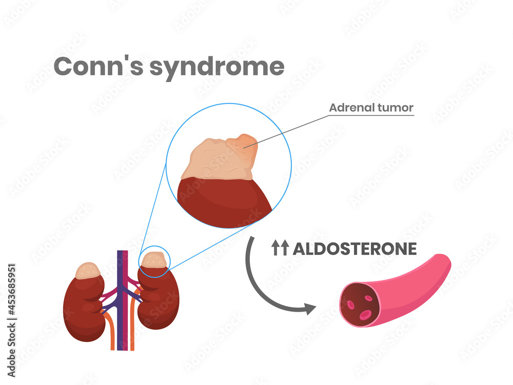 Pathophysiology Vector Conn's syndrome pathophysiology. Primary aldosteronism scientific ...