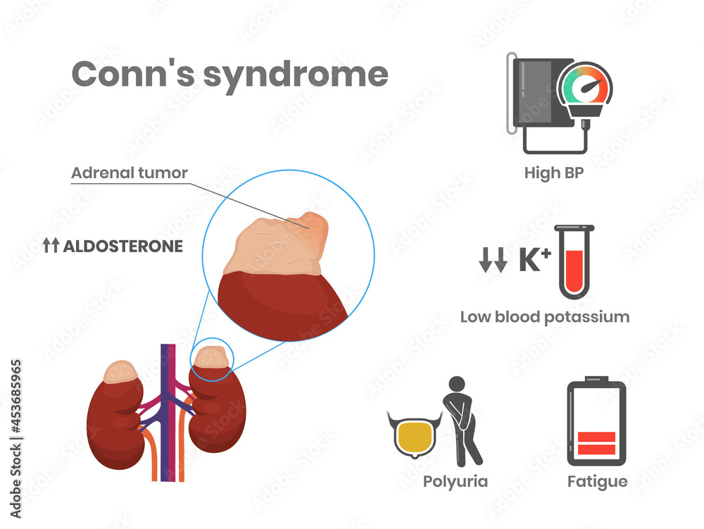 Conn's syndrome causes and symptoms vector illustration. Primary