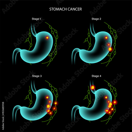 Stomach cancer anatomy