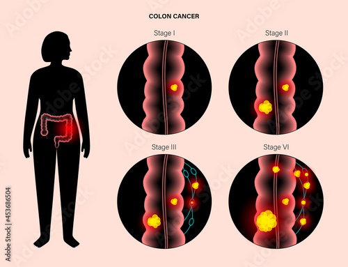 Intestine 3D cancer