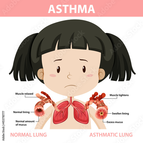Asthma diagram with normal lung and asthmatic lung