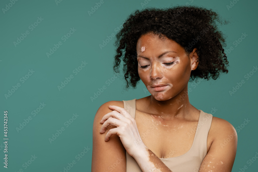 Young woman with vitiligo posing while looking downward Young woman with vitiligo posing while looking downward