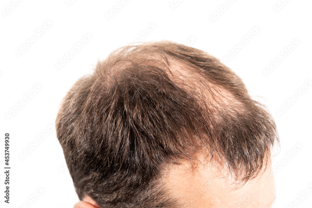 Close-up balding head of a young man on a white isolated background. Close-up balding head of a young man on a white isolated background.