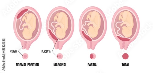 Different Placental Locations During Pregnancy. Normal, marginal, partial and total previa. photo