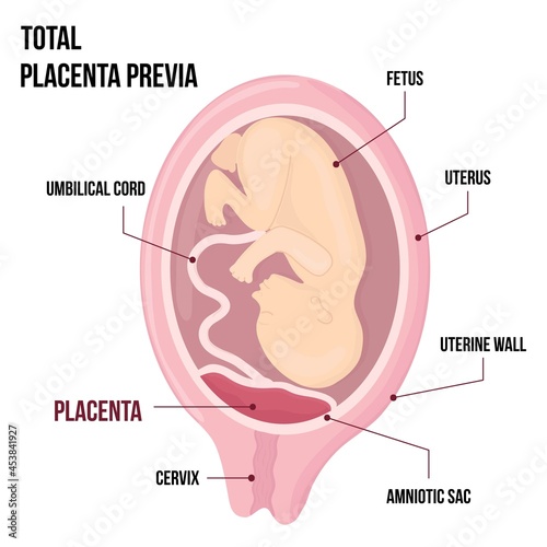 Total Placental previa. Dangerous Placenta Location During Pregnancy. Medical Pathology. detailed medical diagram with table of symbols. photo