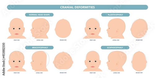 craniosynostosis helmet pillow flat head autism brain skull bone deformity baby infant child newborn defect birth anterior Metopic Born genes genetic position sleep shape deformation tummy time  photo
