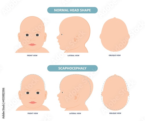 craniosynostosis helmet pillow flat head autism brain skull bone deformity baby infant child newborn defect birth anterior Metopic Born genes genetic position sleep shape deformation tummy time 