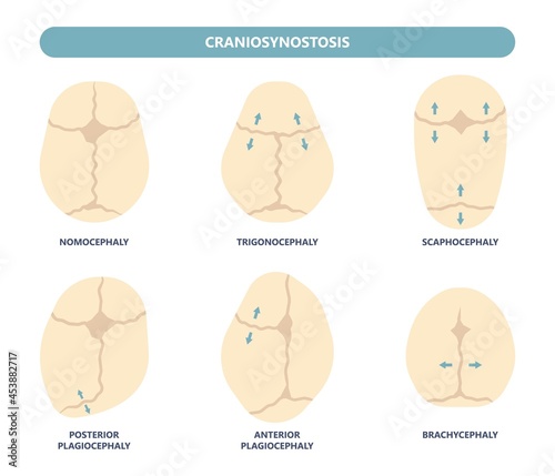 craniosynostosis helmet pillow flat head autism brain skull bone deformity baby infant child newborn defect birth anterior Metopic Born genes genetic position sleep shape deformation tummy time  photo