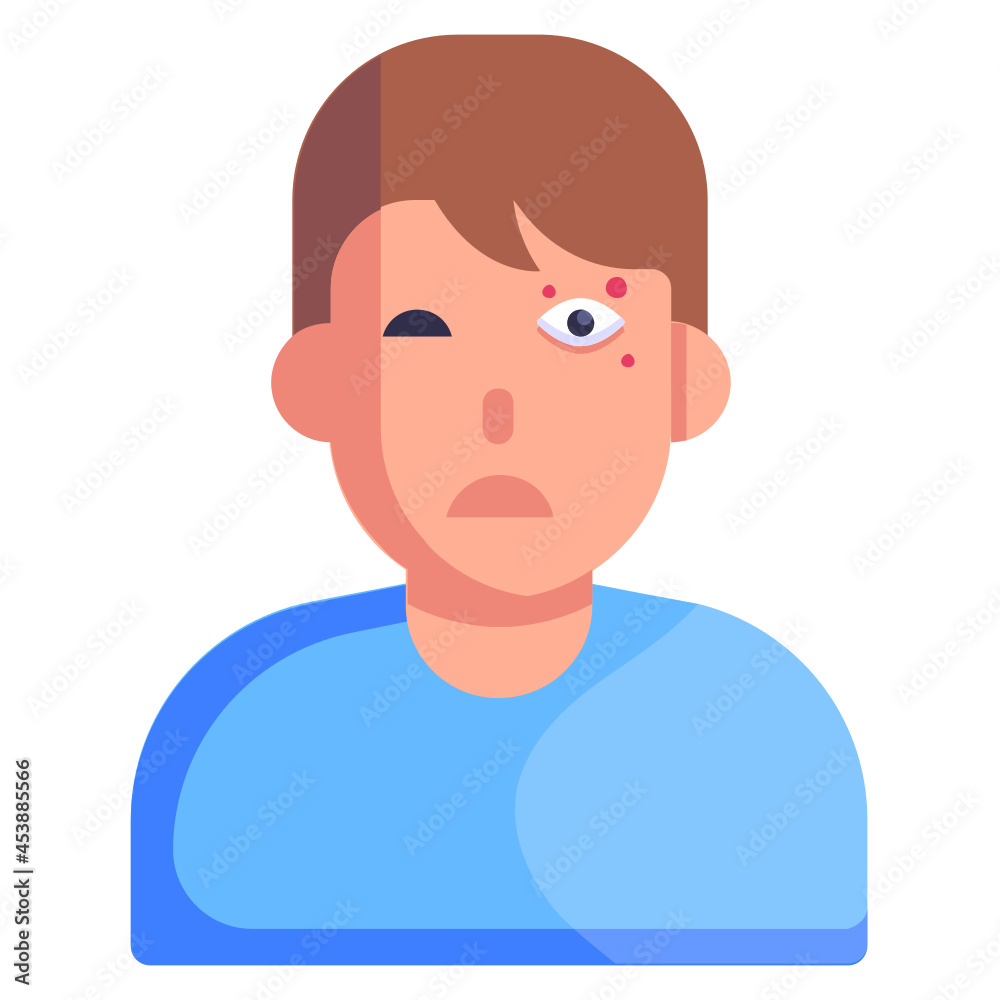 Eye Allergy

