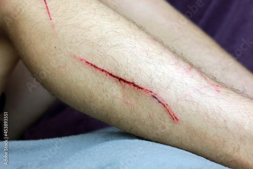 Leinwand Poster A bleeding cut wound on a leg
