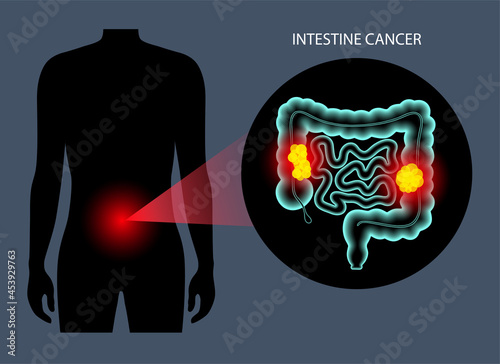 Intestine 3D cancer