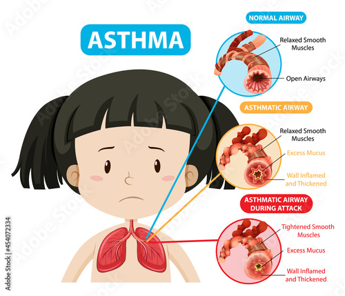 Asthma diagram with normal airway and asthmatic airway