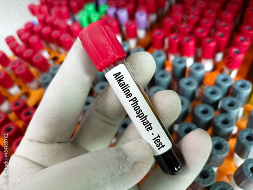 Blood sample tube for ALP or alkaline phosphatase enzyme test, diagnosis for liver disease photo