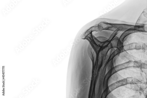 x ray image of a body. Xray image of female shoulder isolated on white background. diagnosis Subacromial Syndrome  photo