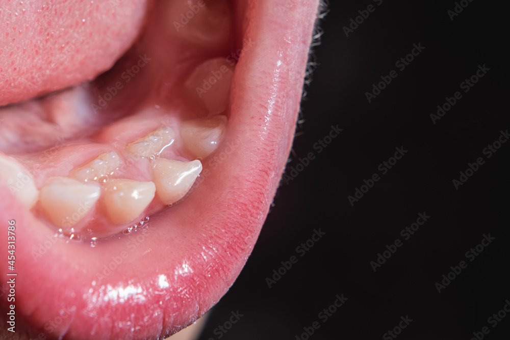 The boy's molars are erupting when the milk teeth have not yet fallen out. Anomaly. Close-up