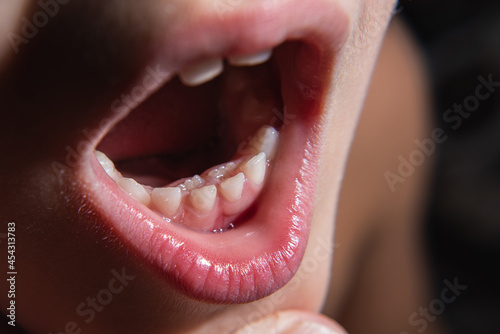 The boy's molars are erupting when the milk teeth have not yet fallen out. Anomaly. Close-up