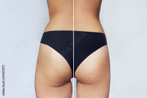 A close-up of female buttocks before and after liposuction or anti-cellulite treatment. Getting rid of excess weight, diet, proper nutrition, training, sports, massage, scrub. Health care, wellness