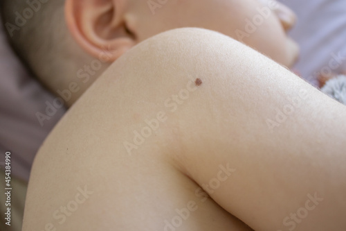 close up photo of a beauty spot (mark) on a kids shoulder. Concept:medicine, dermatology