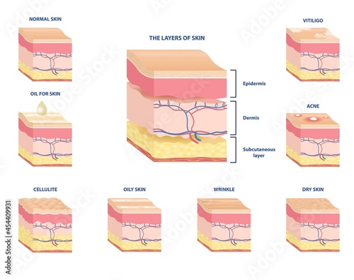 Collection of schemes of various skin types. Subcutaneous tissue, dermis and epidermis. Skin with acne, cellulite, vitiligo. Anatomical structure. Cartoon vector set isolated on white background photo