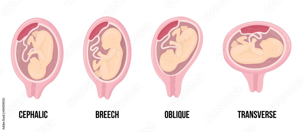 Different wrong baby positions in uterus during pregnancy. Cephalic, Breech, transverse, Oblique lies. Different wrong baby positions in uterus during pregnancy. Cephalic, Breech, transverse, Oblique lies.