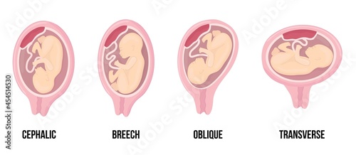 Canvas Print Different wrong baby positions in uterus during pregnancy