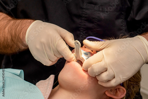 Otrhodontist or dentist making a teeth impression mold. Orthodontic treatment. Dental impression tray photo