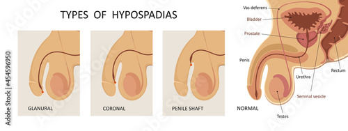 Types of hypospadias. Sideview opening of urethra.